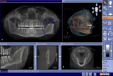 CBCT Dental Imaging Market Analysis and Opportunity Assessment 2019 to 2023
